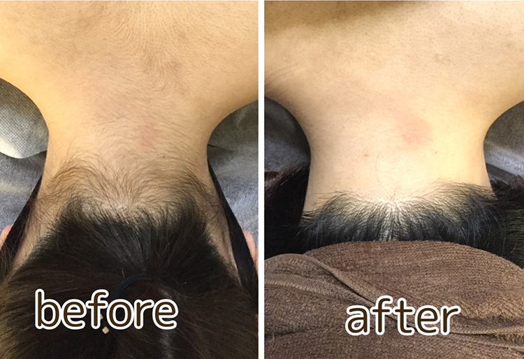 施術ビフォー・アフター